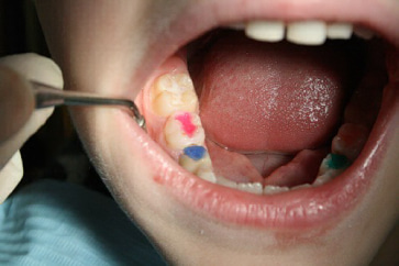Пломбирование молочных зубов Томск Лучистый пломба томск стоматология